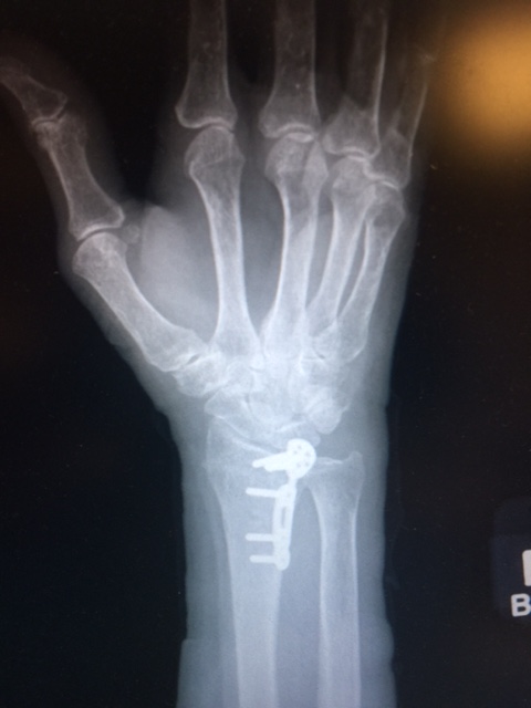 LiveConferences - Sample Digital Book - Distal Radius: An ...